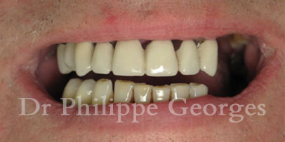 Cas clinique - All on 4 - Cabinet dentaire Serris