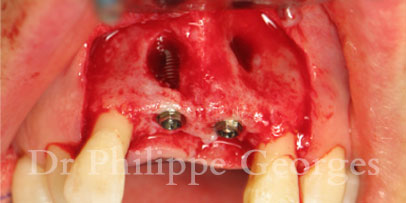 Cas clinique - Extraction et pose d'implant - Cabinet dentaire Serris